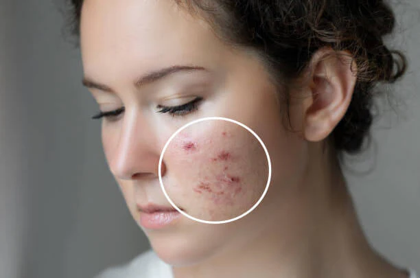 protect your skin from hard water